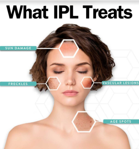 IPL Treatment Areas