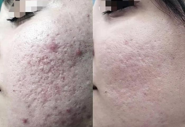 Plexr-FirmX-ToxLift-Facial-Mobile